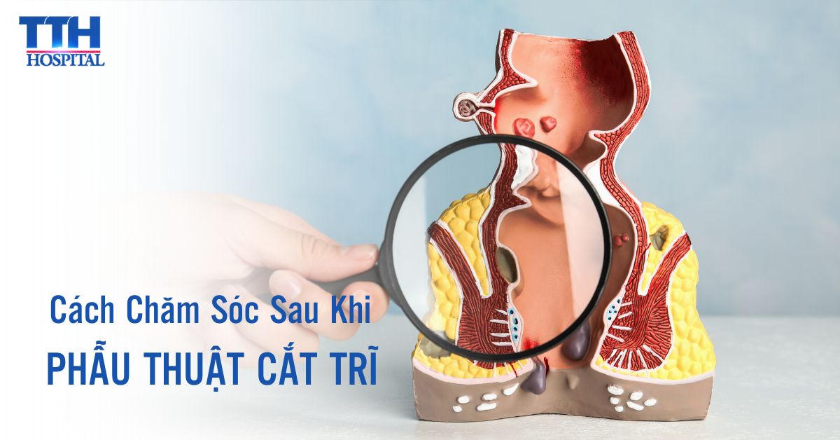 Cách Chăm Sóc Sau Khi Phẫu Thuật Cắt Trĩ
